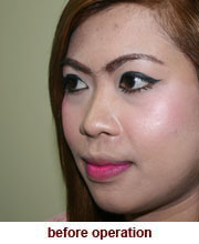 plastic_surgery_augmentation_rhinoplasty